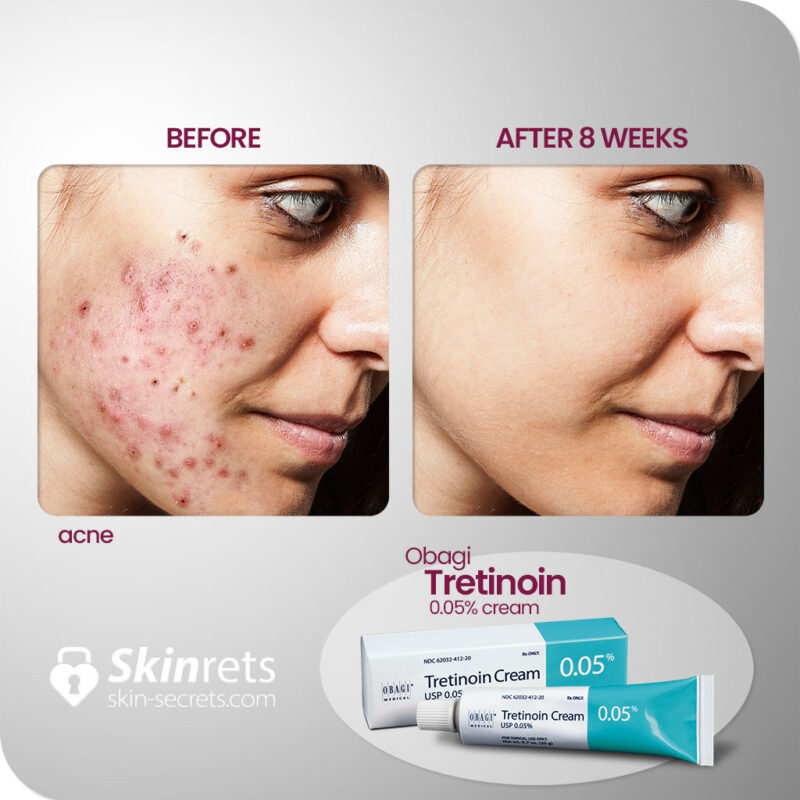 Skinrets obagi tretinion 0.05 cream results