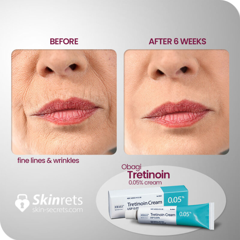 Skinrets obagi tretinion 0.05 cream results