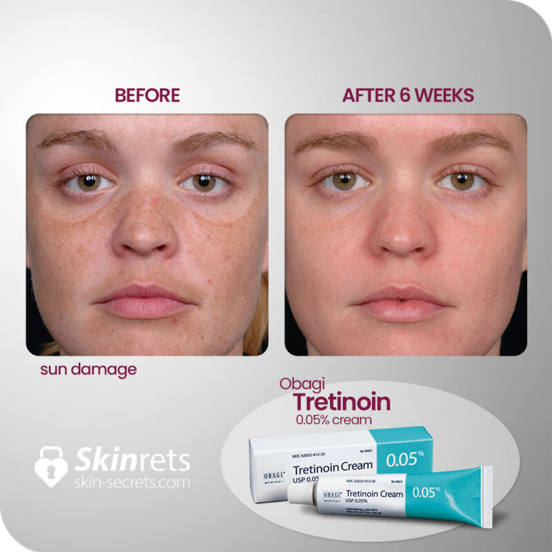 Skinrets obagi tretinion 0.05 cream results