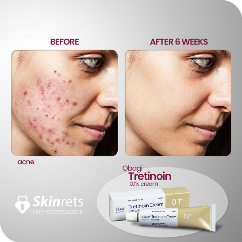 Skinrets obagi tretinion 0.1 cream results