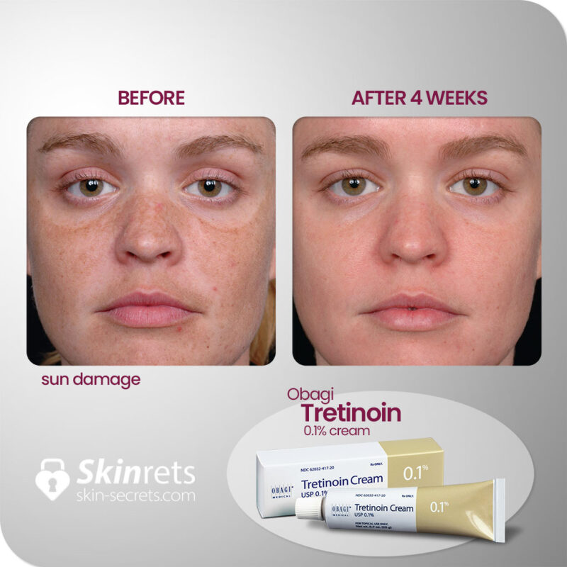 Skinrets obagi tretinion 0.1 cream results